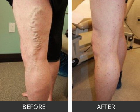 Before and After Varicose Veins