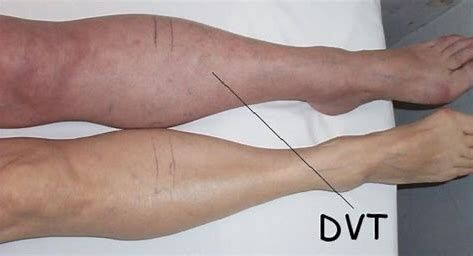 Deep Vein Thrombosis in a Leg