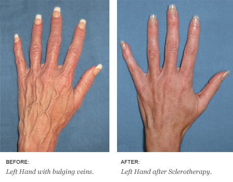 Before and After of a Hand After it goes through a sclerotherapy