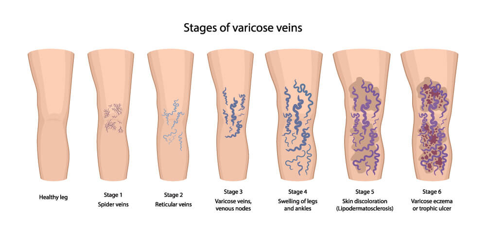 Chart Showing Varicose Veins, Swelling, Skin Changes and Ulcer