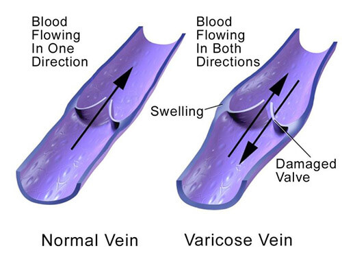Chart Illustrating a Normal Vein Compared to a Varicose Vein